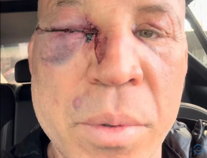 'Fui covardemente agredido', diz Wanderlei Silva sobre briga com Popó